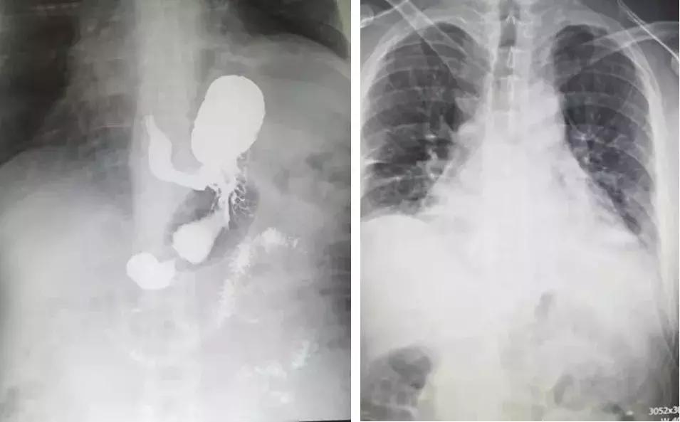 奶牛移位手术,奶牛移胃手术