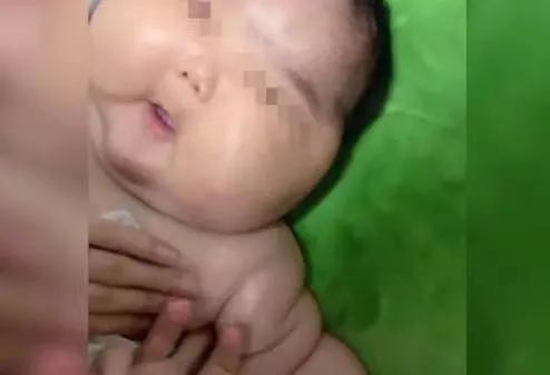 宝宝长期用了强激素面霜,婴儿涂激素面霜有什么症状