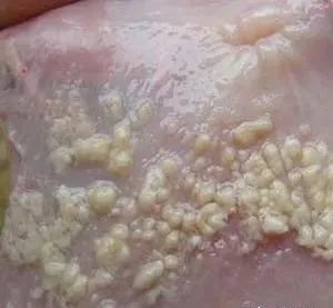 白色念珠菌的防治,霉菌感染白色小颗粒