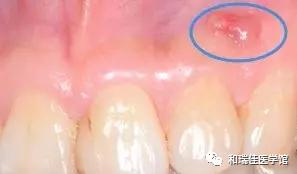牙龈反复长脓包怎么消除最快方法,根管治疗的牙龈反复长脓包怎么办