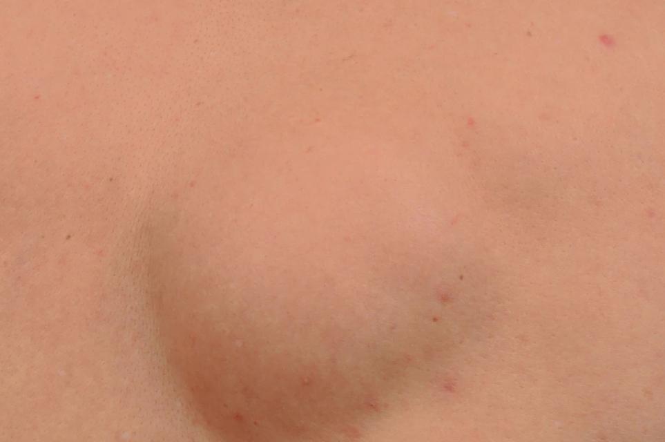 为什么身上会长“肉疙瘩”?是脂肪瘤吗?医生教你如何判断