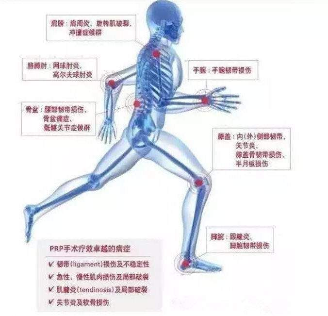 网球肘肩周炎腱鞘炎滑膜炎,富血小板血浆疗法适合网球肘吗