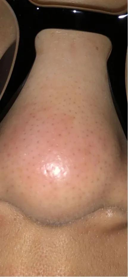 鼻子两侧毛孔粗大是什么原因,毛孔粗大原因及如何改善