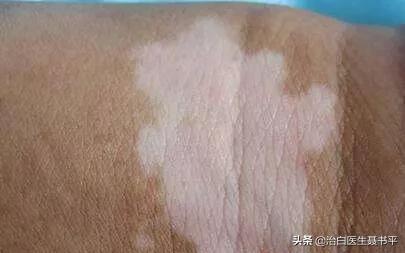 医生无法确定无色素痣还是白癜风,无色素痣误诊白癜风