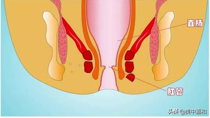 “菊花”附近也会长癌，如何治疗？