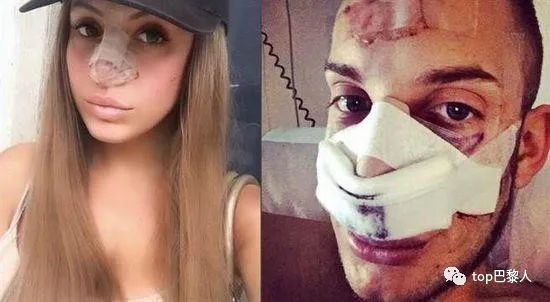 法国情侣豪掷200万，经历15次手术，只为成芭比与肯尼