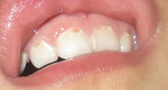 一岁孩子门牙奶瓶龋怎么办,两岁宝宝牙齿有奶瓶龋