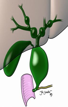 年轻女性反复肚子疼、黄疸、发热，仅仅是胆结石那么简单吗？