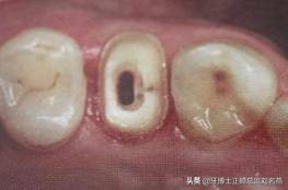 纤维桩修复费用,纤维桩修复全过程视频