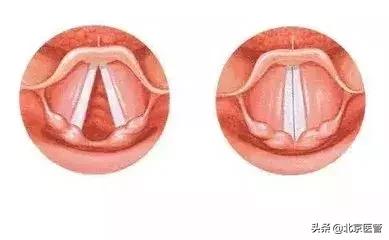 声嘶嘶哑,声音嘶哑是大病前兆