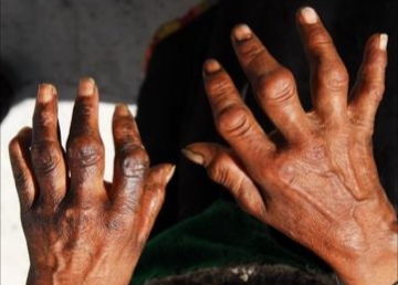 湿痹的表现症状,湿痹表现