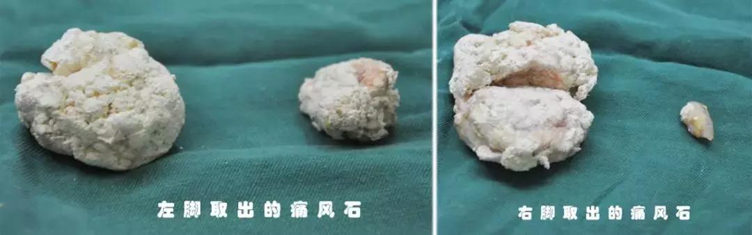 痛风脚踝有痛风石怎样才能变小,痛风石是引起痛风的根本原因吗