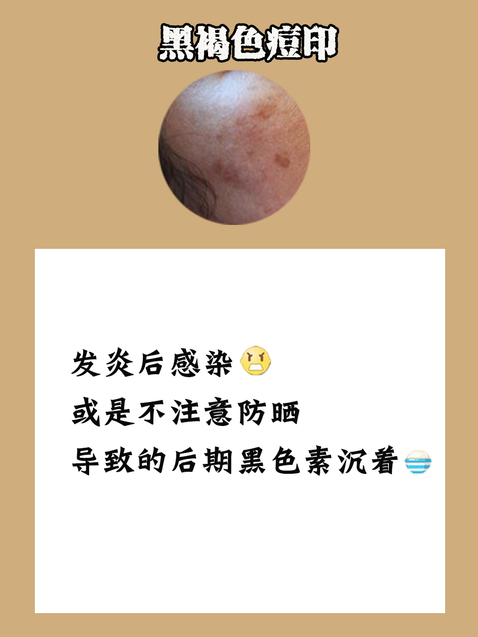 有什么祛痘印方法,简单有效祛痘印方法