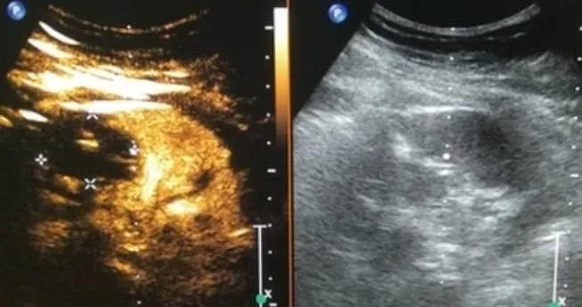 120万一针治疗肿瘤,肿瘤免疫针多少钱一针