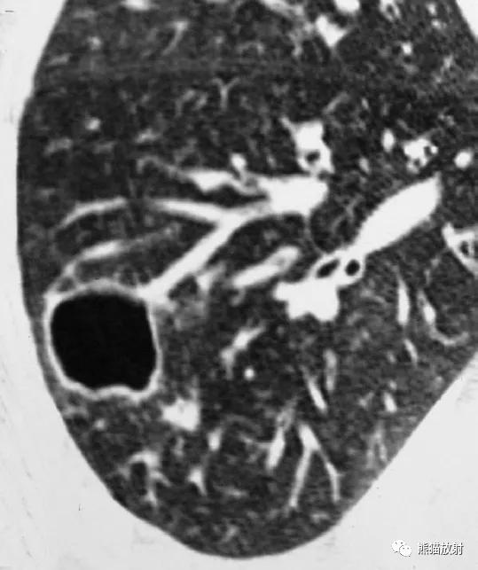 肺部感染并发症,老人新冠引起肺部并发症