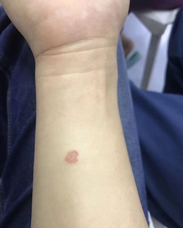 养猫孩子长猫癣什么原因,人得了猫癣怎么养猫