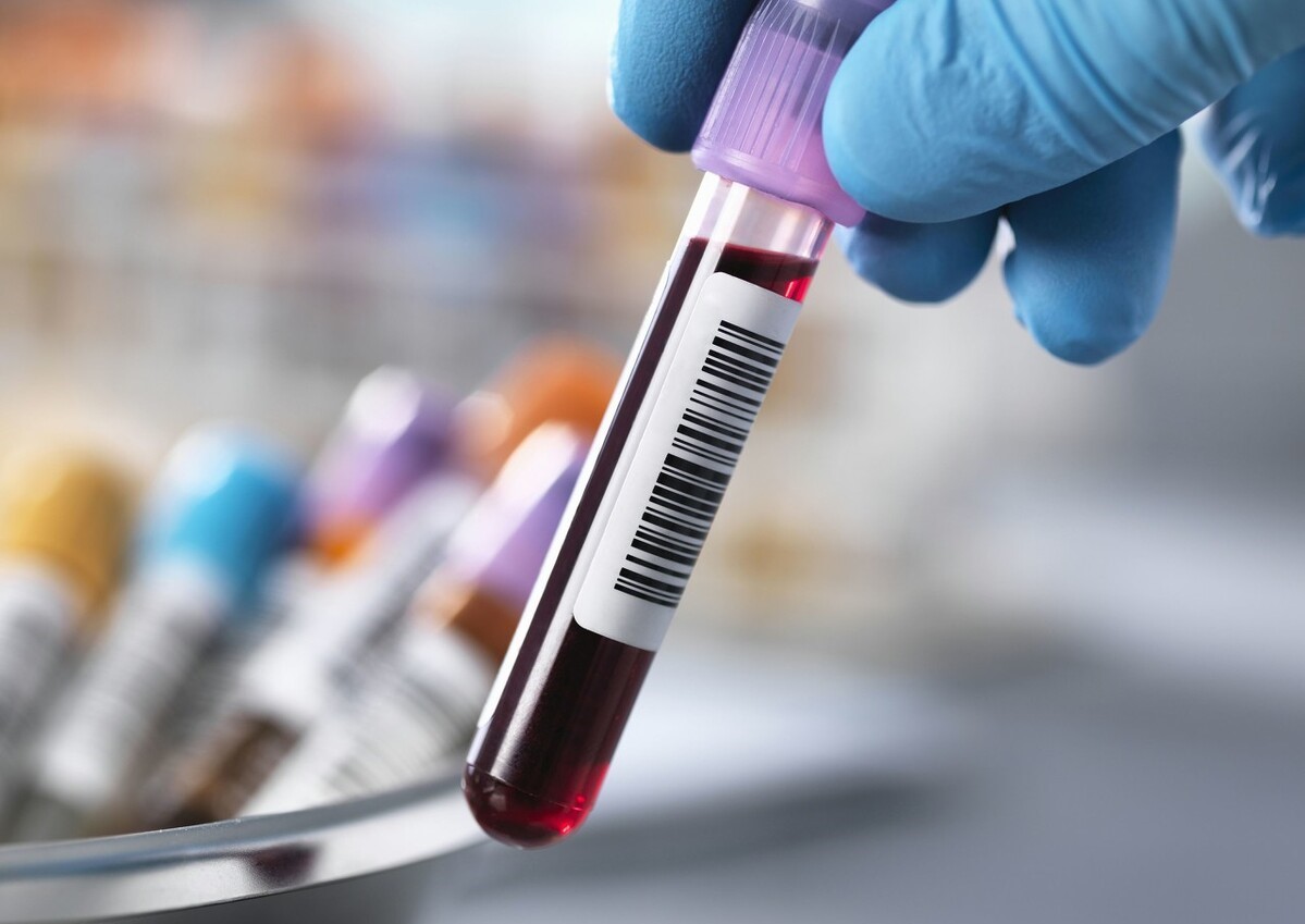 桥本甲状腺炎会使抗核抗体阳性吗,甲状腺抗体高一点就是桥本吗