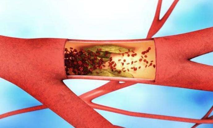 同型半胱氨酸高会影响脑血管病吗 (缺血性脑血管病高同型半胱氨酸)