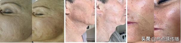 MESOSHINE艾丽思法国医疗级黑科技医美品牌将登入中国