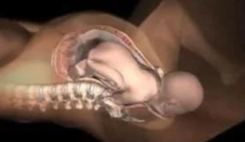 一分钟了解剖宫产视频,30秒了解剖宫产