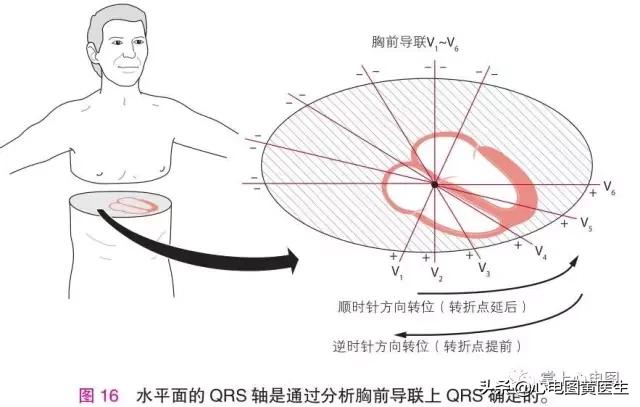 心电图中qrs顺钟转位什么意思,心电图什么是qrs顺钟转位