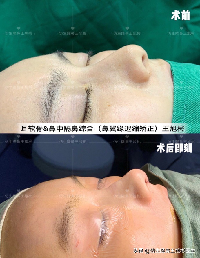 王旭彬:朝天鼻、露鼻孔,模特菲菲短鼻矫正手术后1.5个月