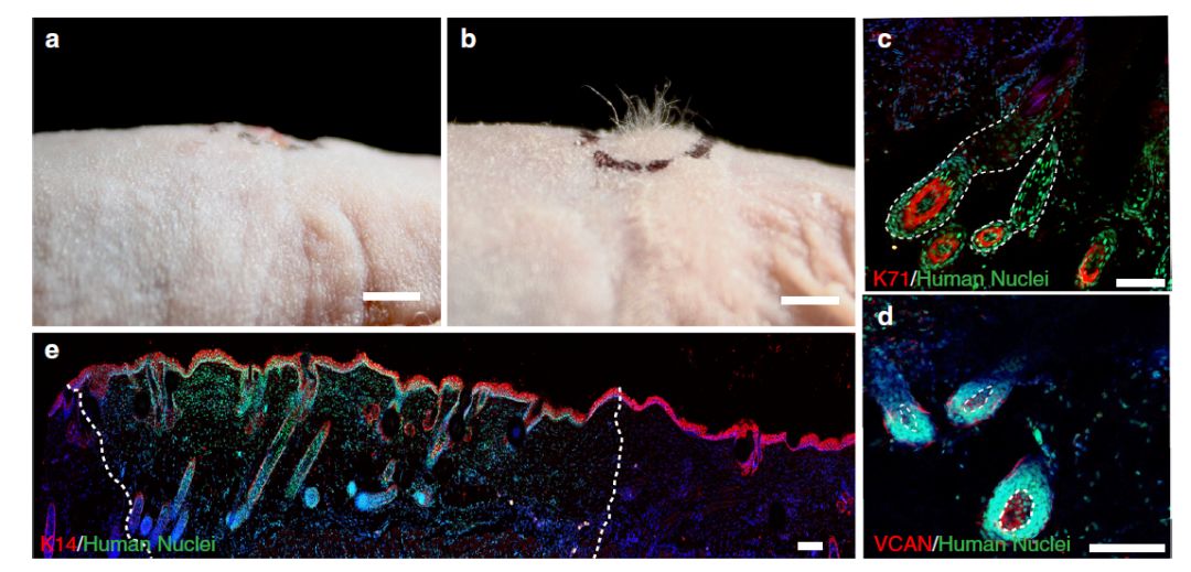 3d打印毛囊工厂,3d打印毛囊移植