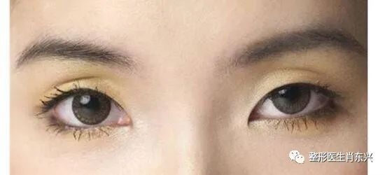 双眼皮埋线和割双眼皮有什么区别,除了割双眼皮怎么可以变成双眼皮