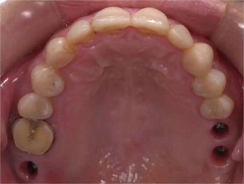 北大口腔医院儿童口腔科龋齿防治,哪家牙科医院治疗儿童龋齿好