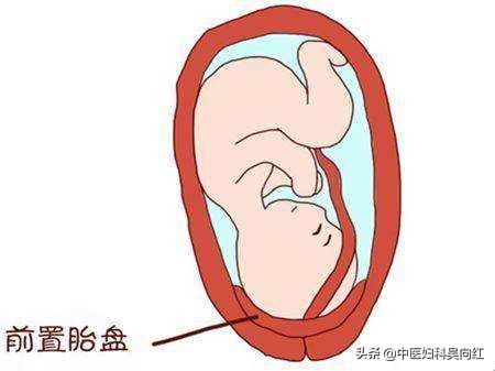 怀孕红点点是怎么回事,怀孕红点点是什么原因