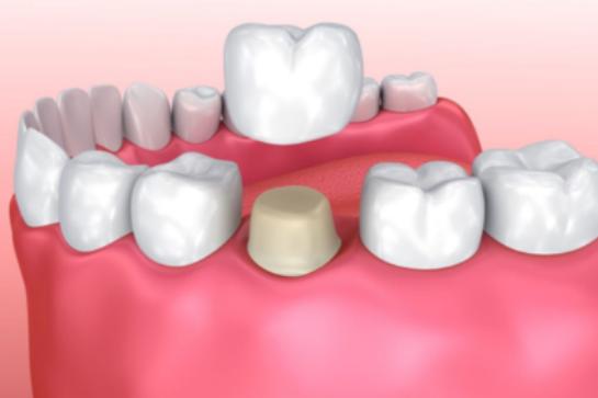 全瓷牙好还是烤瓷牙好,全瓷牙好还是单纯补牙好