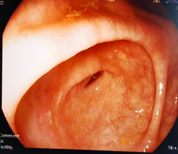 直肠癌吻合口狭窄的症状,直肠癌术后吻合口狭窄什么原因