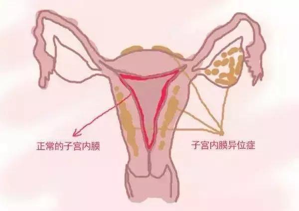 曼月乐避孕环多久有避孕效果,曼月乐避孕环是怎么避孕