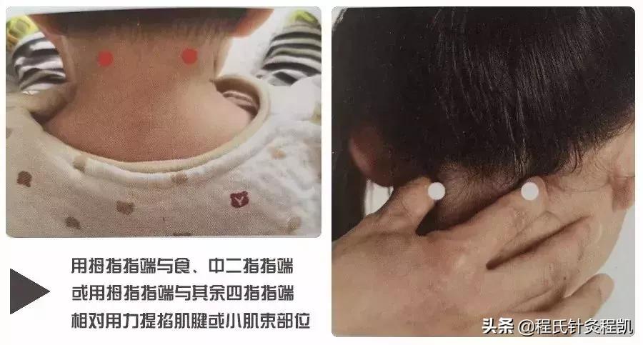 小儿荨麻疹中医反射推拿,荨麻疹夏季如何预防虫咬皮炎