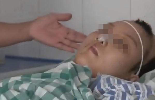 脂肪填充15天恢复照片脸型很满意,脂肪填充手术改善大小脸过程