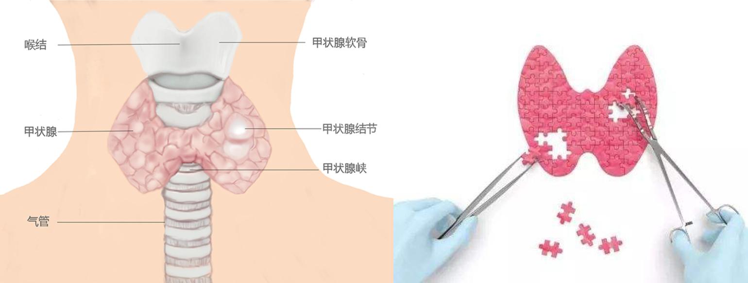 甲状腺超声TI-RADS,甲状腺TI-RADS分级标准有哪几个
