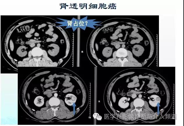 ct造影剂过敏反应及处理方法,增强ct碘过敏该用什么造影剂