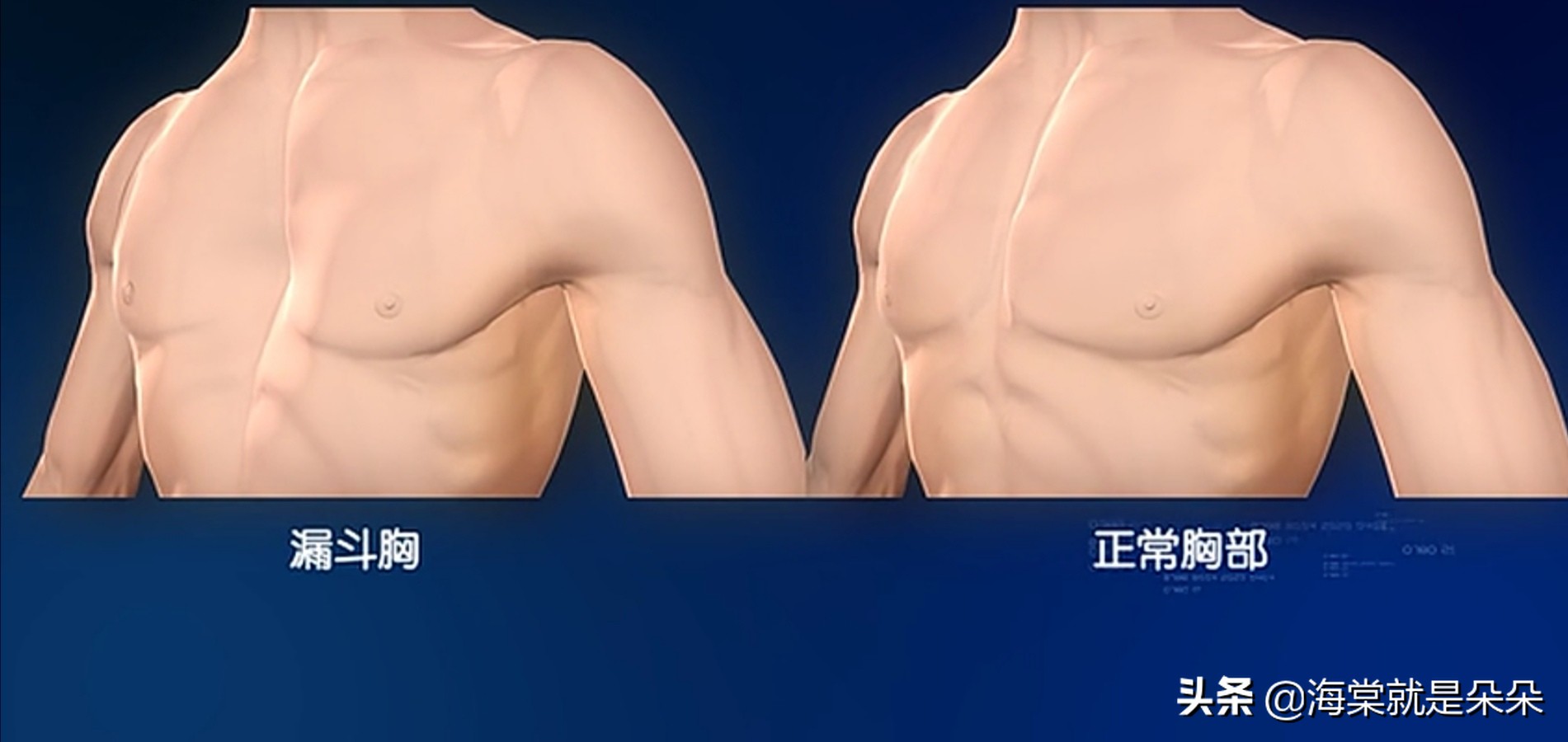 先天漏斗胸跟心脏不好有关吗,成年人漏斗胸压迫心脏