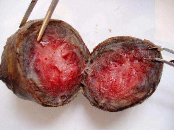 子宫肌瘤变性b超报告单会提示吗,查出子宫肌瘤囊性变怎么办