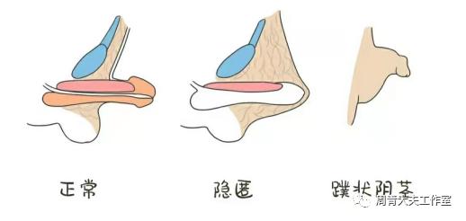 家长带孩子割包皮先了解这4点,家长陪孩子去医院割包皮