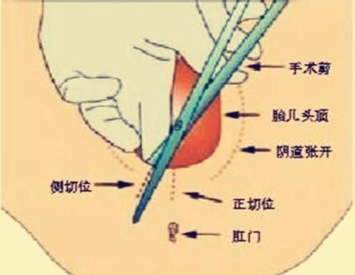 顺产难产需要产钳助产是什么原因,产妇难产为什么不侧切用产钳