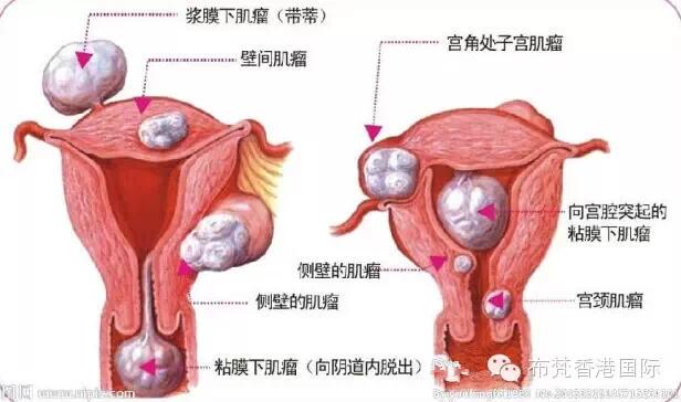 宫寒引起的妇科炎症怎么治,宫寒西医的解释是什么