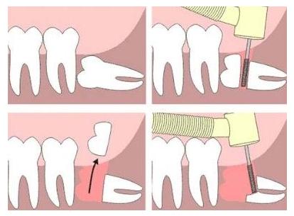 所有人拔智齿都会肿吗,智齿拔了以后智齿还有什么用