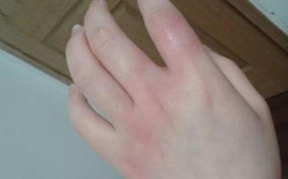 皮肤科外用软膏大全脂溢性皮炎,常见的皮肤科药