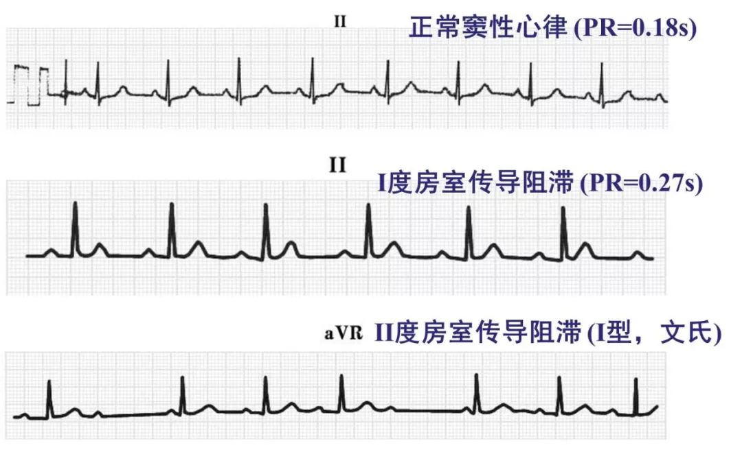 心律失常55分钟讲解,心律失常心电图讲解视频教程全集