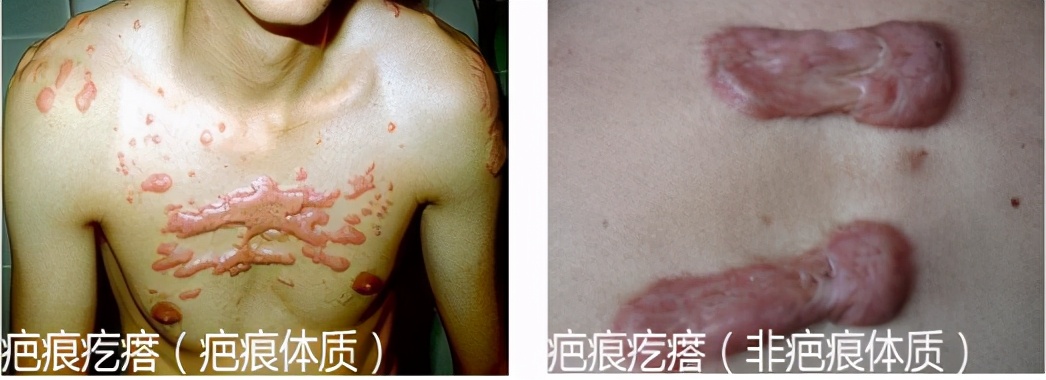 「掌健识」可恶的瘢痕疙瘩，你知道怎么去掉吗？