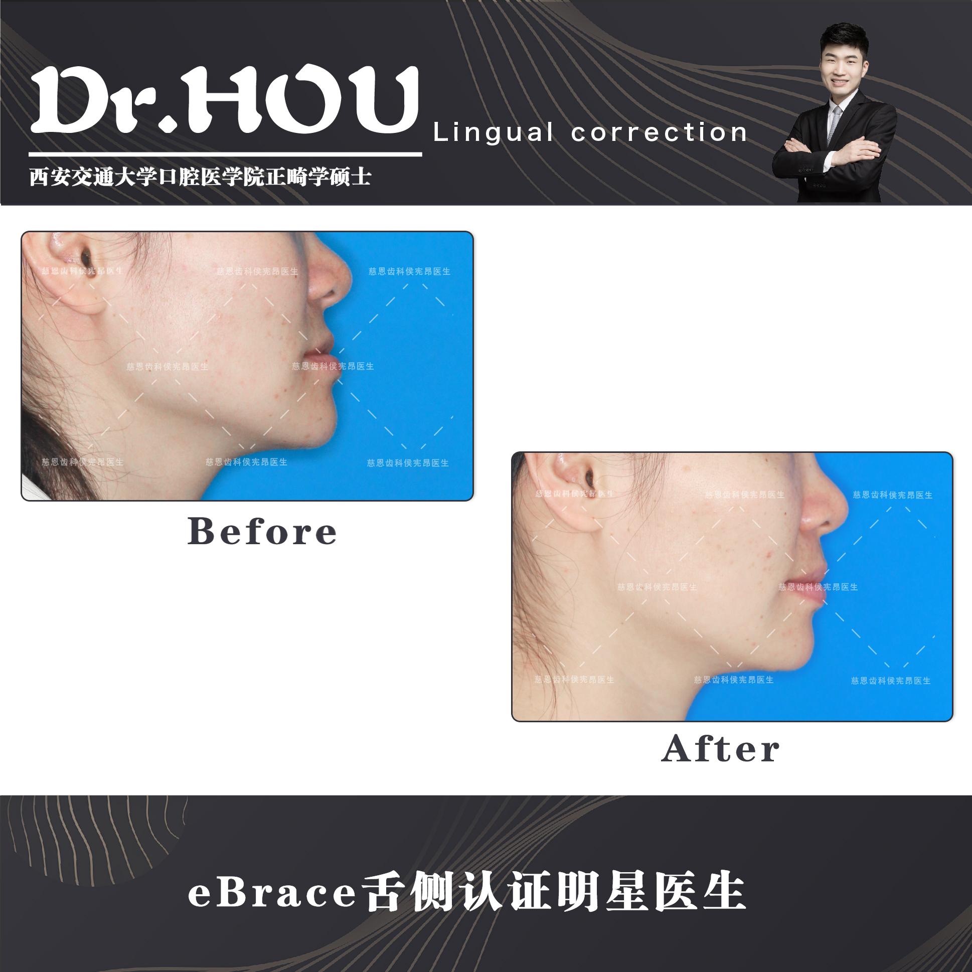 地包天的牙齿图片,牙齿地包天怎么补救