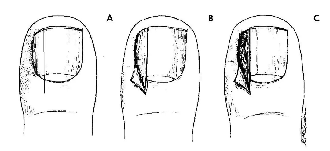 指甲老往肉里长化脓,指甲为什么一直往肉里长