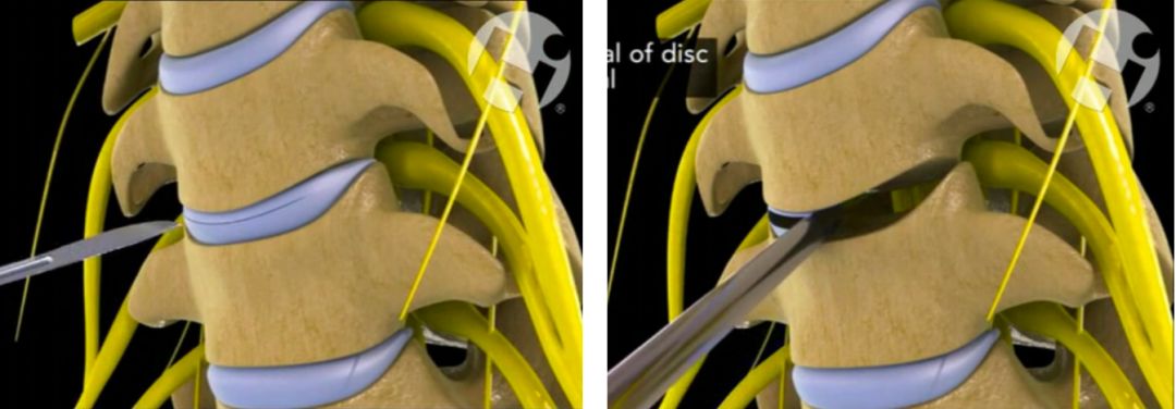颈椎病是保守治疗还是手术治疗好,颈椎病做什么手术比较安全