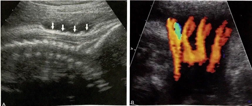胎儿脐带绕颈有什么症状,胎儿脐带绕颈的症状有哪些